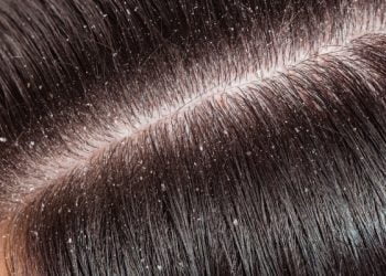How To Get Rid Of Dandruff: Winter Care Solution