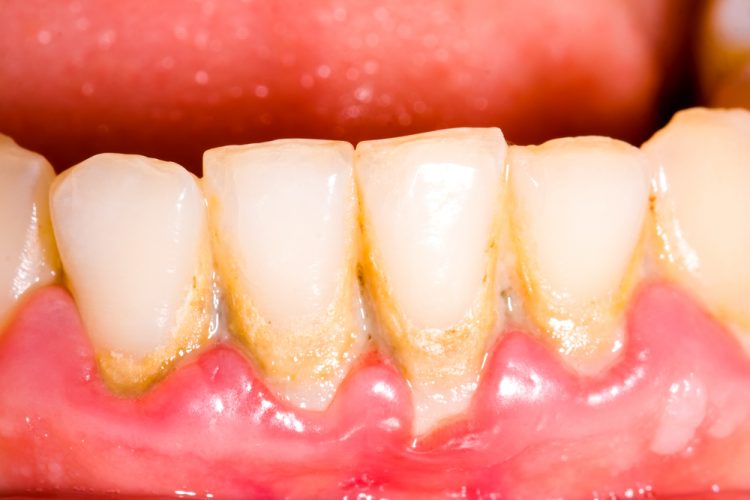 Keeping up With Solid Teeth and Gums With Legitimate Oral Consideration is a Long-lasting Responsibility
