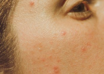 ​​7 Tips for Combining Sunscreen With Your Acne Meds