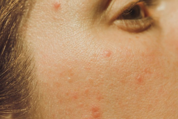 7 Tips for Combining Sunscreen With Your Acne Meds