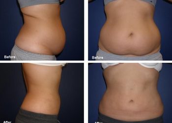 What is Laser-assisted Liposuction?