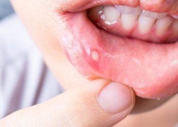7 Ways to Take Care of Your Cold Sore