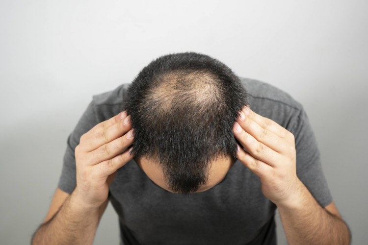 5 Hair Loss Myths You Should Never Believe – And The Truth Behind Them