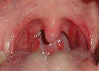 10 Home Remedies for a Sore Throat