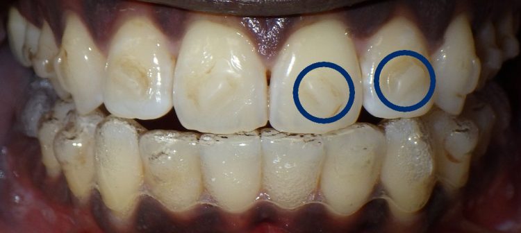 What Clear Aligners Attachments Are and When They Should Be Used?