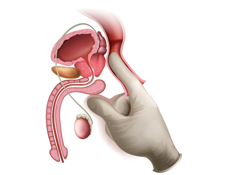 Vasectomy reversal: Understanding the process and purpose