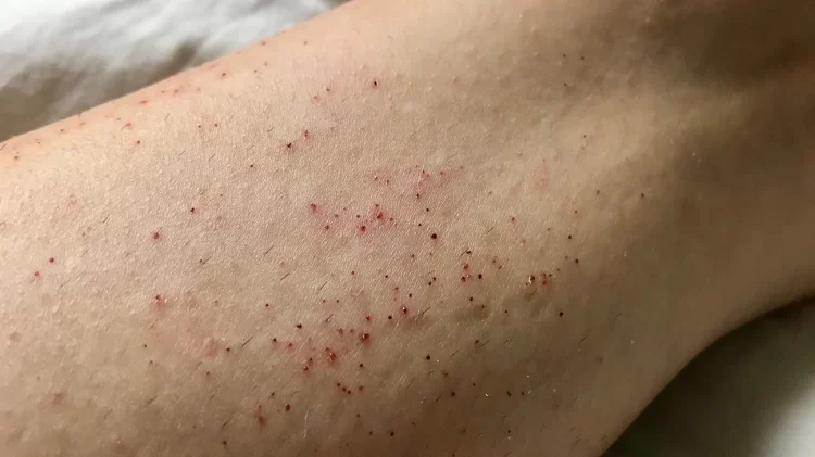 From Flaking to Smooth: Tips on How to Shave Ingrown Hairs and Razor Bumps