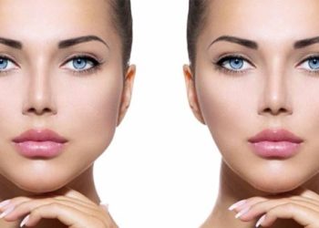 Everything about Buccal Fat Removal (Bichectomy)