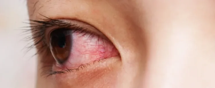 Which are the Most Common Eye Conditions